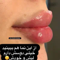 تزریق فیلر ،بوتاکس،جوانساز