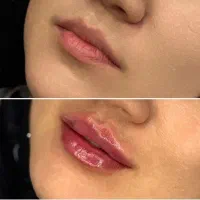 تخفیفات مدل ژل بوتاکس مزو،پاکسازی و جوانسازی صورت|خدمات آرایشگری و زیبایی|مشهد, طلاب|دیوار