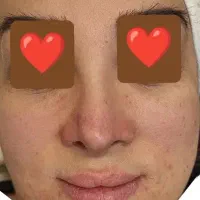 فیشیال 18 مرحله ای با هدیه رفع چروک دور چشم رایگان