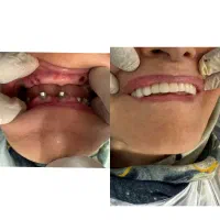 جراحی ایمپلنت( نمایندگی دنتیس )|خدمات آرایشگری و زیبایی|تهران, میدان ولیعصر|دیوار