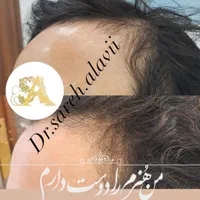 درمان ریزش مو توسط پزشک|خدمات آرایشگری و زیبایی|قم, دورشهر|دیوار