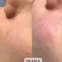 سفیدکردن بیکینی،زیربغل،صورت (کلینیک ایرانا)|خدمات آرایشگری و زیبایی|یاسوج, |دیوار