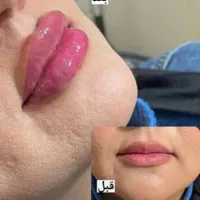 آموزش ژل،بوتاکس،لیفت،فیلربادی،انواع مزو مو و پوست