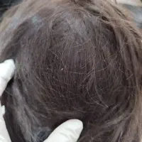 مرکز تخصصی درمان رشک وشپش سر|خدمات آرایشگری و زیبایی|قم, شهرک فاطمیه|دیوار