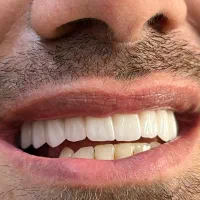 پروتز کامل و دندان مصنوعی|خدمات آرایشگری و زیبایی|تهران, پرستار|دیوار