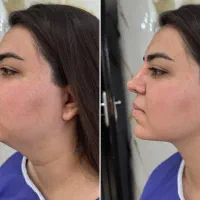 مرکز تخصصی ساکشن غبغب۵۰۰+ نمونه‌کار واقعی اقساطی