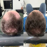 تقویت رشد طبیعی مو