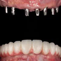 دندانپزشکی تخصصی/ ایمپلنت/ لمینت/ روکش زیبایی