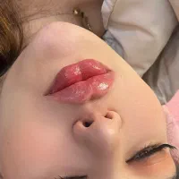 آموزش تزریق ژل و بوتاکس