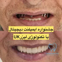 هر۴واحد ایمپلنت دیجیتال+1ایمپلنت رایگان/کاشت دندان