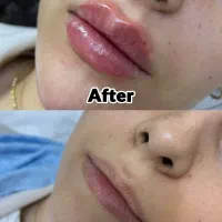 خال برداری، پاک کردن تتو، بلفاروپلاستی در تهران|خدمات آرایشگری و زیبایی|باقرشهر, |دیوار