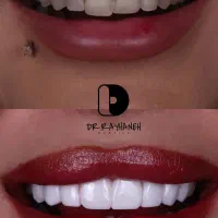 کامپوزیت دندان/لمینیت/دندانپزشکی|خدمات آرایشگری و زیبایی|مشهد, کوثر|دیوار