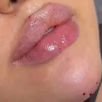 کلیه خدمات فیلر و بوتاکس