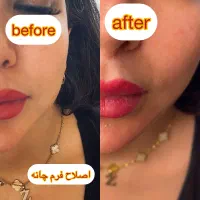 جشنواره فیلروبوتاکس مادلینگ‌صورت باتخفیف ویژه
