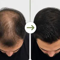 بدون کاشت مو در بیار