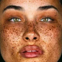 درمان و لیزر تضمینی کک و مک و لک فقط در 1 جلسه|خدمات آرایشگری و زیبایی|اصفهان, لاله|دیوار