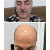 جشنواره ویژه کاشت مو و ابرو|خدمات آرایشگری و زیبایی|رشت, بوسار|دیوار