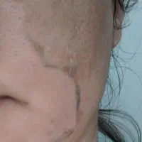 فشیال درمانی و پاکسازی  با 50% تخفیف
