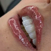 تخفیف ویژه خدمات ایمپلنت دندان فوری اقساطی با وام