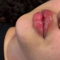 انجام خدمات  ژل و بوتاکس