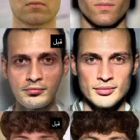 جشنواره تابستانه تزریق ژل، بوتاکس و...|خدمات آرایشگری و زیبایی|تهران, فرمانیه|دیوار