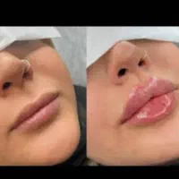 تزریق ژل و بوتاکس تضمینی|خدمات آرایشگری و زیبایی|اهواز, نادری|دیوار