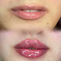 مطب پزشک.ژل وبوتاکس.لیفت بانخ.فیلربینی ژل آلت|خدمات آرایشگری و زیبایی|قم, دورشهر|دیوار