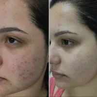 کرم ضدلک و‌جوش و سفید کننده|آرایشی، بهداشتی، درمانی|دهدشت, |دیوار