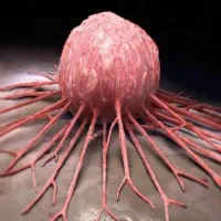 درمان تضمینی پروستات و مشکلات ادرار