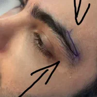 کاشت اصولی ابرو با دو سبک جراحی وبدون جراحی