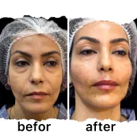 تزریق ژل|خدمات آرایشگری و زیبایی|رشت, حاجی آباد|دیوار
