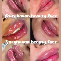 ژل و بوتاکس مزوتراپی و مزونیدلینگ آرایش دایم