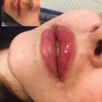 تخفیف* خدمات ژل وبوتاکس حمیدیه*