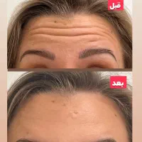 تخفیف بوتاکس و آنزیم