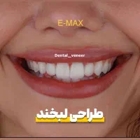 دندانپزشکی دنتال ونیر کامپوزیت لمینت ایمپلنت|خدمات آرایشگری و زیبایی|تهران, تجریش|دیوار