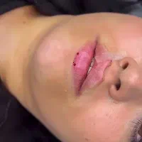 ژل،بوتاکس
