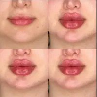 ژل بوتاکس950فقط تا8تیر مزوتراپی مزوژل تخصصی درمشهد