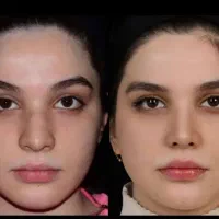 ساکشن غبغب عمل  بینی فقط ۳۰ تومن فیلر بادی