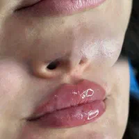 تزریق فیلر و بوتاکس وانجام اگزوزوم تراپی