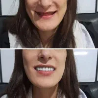 دندان مصنوعی - دندانسازی -تخفیف ویژه و تعرفه دولتی|خدمات آرایشگری و زیبایی|مشهد, فاطمیه|دیوار