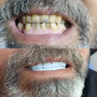 جشنواره خدمات زیبایی دندان با افر 60٪ از دست ندید