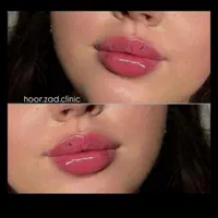 تزریقات تخصصی فیلر(ژل)وبوتاکس