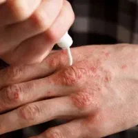 درمان پسوریازیس وصدف|آرایشی، بهداشتی، درمانی|بندر کنگان, |دیوار