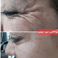 لیزر بوتاکس ژل خالبرداری