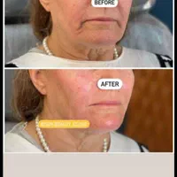 هایفوتراپی14بعدی برای نخستین بار در غرب کشور