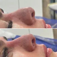 لیفت تخصصی صورت و ابرو فقط امرور با ۴۰ درصد تخفیف|خدمات آرایشگری و زیبایی|شیراز, بعثت|دیوار
