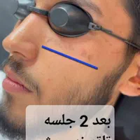 لیزر تاتو و خالکوبی و جوانسازی پوست(کر۰بنتراپی)|خدمات آرایشگری و زیبایی|محمدشهر, |دیوار