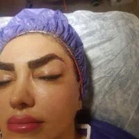 دایرکت ابرو در کلینیک تخصصی پرسابقه
