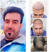 کاشت مو سوزن ۰/۷،کاشت ابرو کره ای(تیم شیراز در یزد|خدمات آرایشگری و زیبایی|یزد, |دیوار