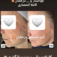 کرم انحصاری درخشان بدون بازگشت|آرایشی، بهداشتی، درمانی|رشت, منظریه|دیوار